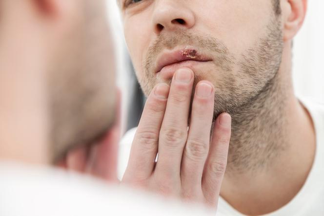 Herpes labialis, или герпес на губах. Как его лечить и как предотвратить герпес?