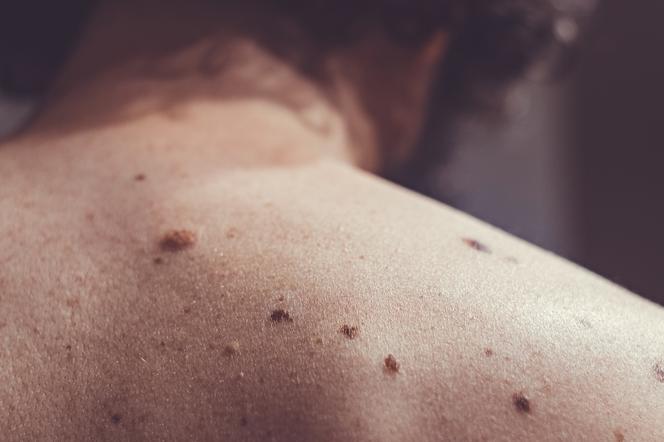 Создан «раковый пластырь», он уничтожает раковые клетки. Будет ли прорыв в лечении?