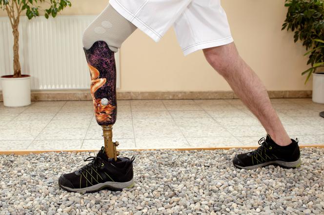 Фантомная боль: когда болит то, чего нет.
